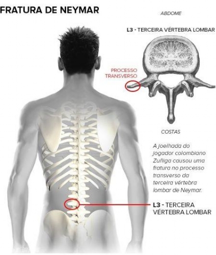 图解内马尔脊椎伤情:无需手术 最快一周可恢复
